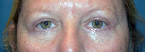 bul and bll bleph and brow lift after1.4 - Bruce Becker MD